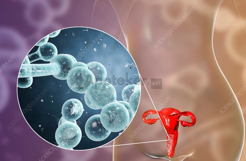 Yang Harus Anda Ketahui Tentang Infeksi Candida